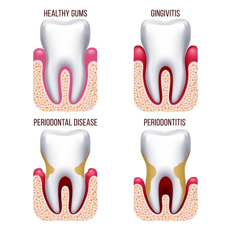 Progression of Periodontal Disease